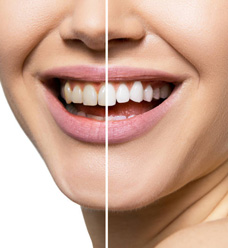 Teeth Whitening